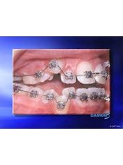 Damon™ Braces - Milda Dental Care Orthodontic Specialist