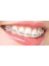 Clear Braces - Milda Dental Care Orthodontic Specialist