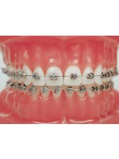 Accelerated Braces™ - Milda Dental Care Orthodontic Specialist