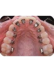 Lingual Braces - Milda Dental Care Orthodontic Specialist