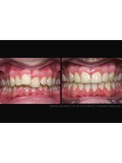Braces - Milda Dental Care Orthodontic Specialist