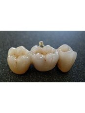 Dental Bridges - Milda Dental Care Orthodontic Specialist