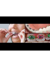 Lingual Braces - Milda Dental Care Orthodontic Specialist
