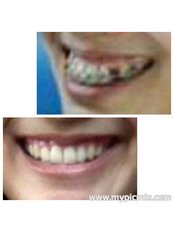 Adult Braces - Milda Dental Care Orthodontic Specialist