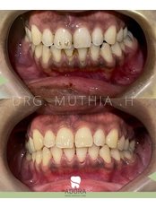 Teeth Cleaning - Adora Dental Clinic