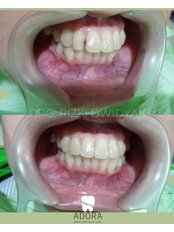 Fillings - Adora Dental Clinic