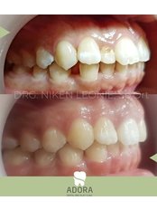 Invisalign™ - Adora Dental Clinic