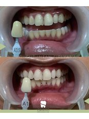 Teeth Whitening - Adora Dental Clinic