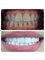 Elite Dental Clinic Jakarta - HOLLYWOOD SMILE  