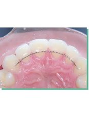 lingual fixed retainer - Elite Dental Clinic Jakarta
