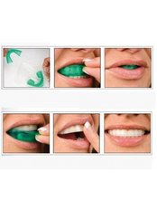 Home Whitening Kits - Elite Dental Clinic Jakarta