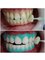 Elite Dental Clinic Jakarta - TEETH WHITENING 
