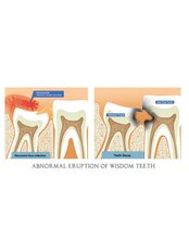 Wisdom Tooth Extraction - Elite Dental Clinic Jakarta