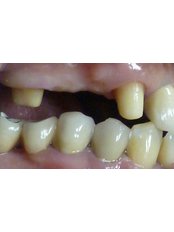 Dental Bridges - Escalade Dental Care Specialist