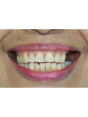 Removable Partial Dentures - Escalade Dental Care Specialist