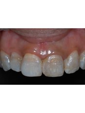 Porcelain Crown - Escalade Dental Care Specialist