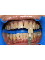 Teeth Whitening - Escalade Dental Care Specialist
