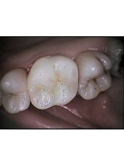 Porcelain Inlay or Onlay - Escalade Dental Care Specialist
