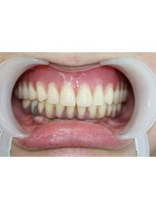 Full Dentures - Escalade Dental Care Specialist