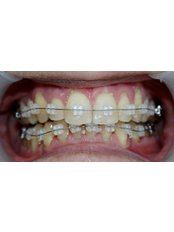 Ceramic Braces - Escalade Dental Care Specialist