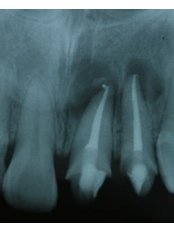 Root canals - Escalade Dental Care Specialist