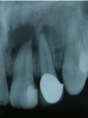 Root canals - Escalade Dental Care Specialist