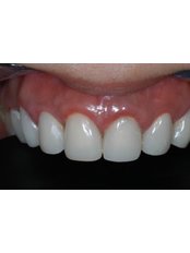 Porcelain Crown - Escalade Dental Care Specialist