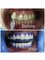 Hanni's Aesthetic & Implant Centre - Bleaching result in 1 Visit 