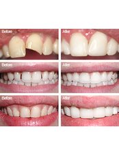 Dental Bonding - Jakarta Smile - Family Dental