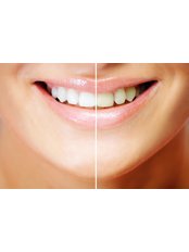 Teeth Whitening - Jakarta Smile - Family Dental