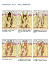 Endodontist Consultation - Jakarta Smile - Family Dental