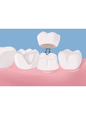 Dental Crowns - Jakarta Smile - Family Dental