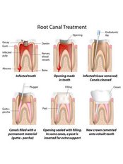 Root canals - Jakarta Smile - Family Dental-Kenmanggisan