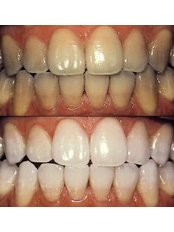 Teeth Whitening - Jakarta Smile - Family Dental-Kenmanggisan