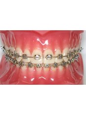 Orthodontist Consultation - Jakarta Smile - Family Dental-Kenmanggisan