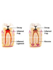 Endodontist Consultation - Jakarta Smile - Family Dental-Plaza Semanggi