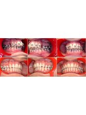 Orthodontist Consultation - Klinik Gigi Orchid