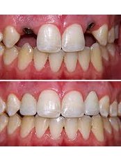 Dental Implants - Klinik Gigi Orchid