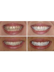 Teeth Whitening - Klinik Gigi Orchid
