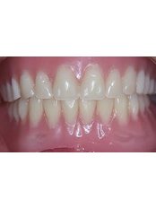 Dentures - Klinik Gigi Orchid