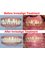Linus Boekitwetan Dental Care Center - Invisalign Invisible Braces 