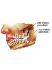 Surgical Extractions - Natura Dentica Dental Studio