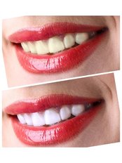 Whitening Top Up Treatment - Natura Dentica Dental Studio