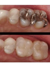 Dental Bonding - Natura Dentica Dental Studio