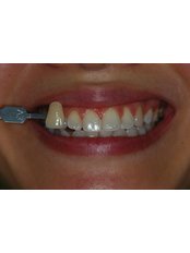 Home Whitening Kits - Sapphire Dental Aesthetic