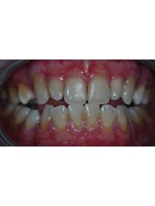 Zoom! Teeth Whitening - Sapphire Dental Aesthetic
