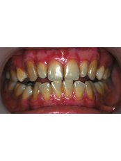 Zoom! Teeth Whitening - Sapphire Dental Aesthetic