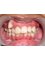 Arafah Orthodontic Clinic - before treatment 