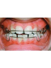 Removable Braces - LaDenta Dental Clinic Branch of Hotel Aston