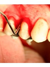Periodontitis Treatment - LaDenta Dental Clinic Branch of Hotel Aston